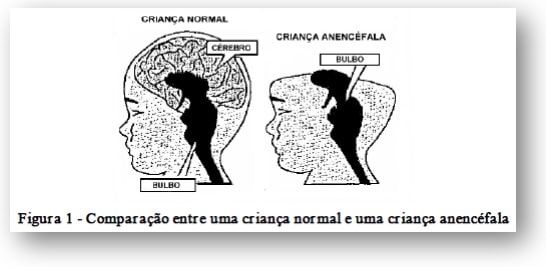 Comparação entre o cérebro de uma criança normal e de uma anencéfala