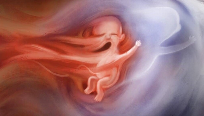 Representação artística (pintura) do momento em que um aborto por sucção começa a separar um bebê pré-nascido do tronco.